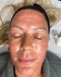 ☀️MICRONEEDLING 💉🧪 How amazing does Donna look after just ONE SESSION! ⭐️  Microneedling produces more than one year of collagen production in one  session. •Tackles fine lines & Scarring •Reduces pigmentation &