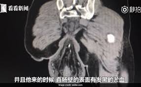 China: Man's Rectum Fell Out Of Body After Sitting On The Toilet For 30  Minutes