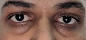 got sunken/hollow eyes and dark circles