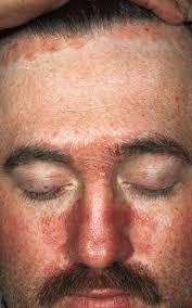 Aveam deja o piele uscata de cand eram copil. Dermatita Seboreica Fata Poze Wasatchpremiermovers Com