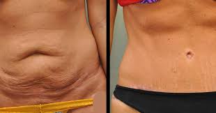 If the tummy tuck involves tightening the abdominal muscles, full healing can take several months. Mommy Makeover Recovery Time Tips Sprsi Blog