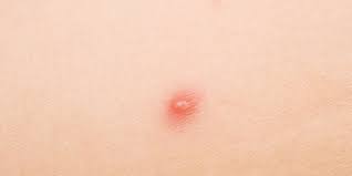 And my vagina is really swollen. Yes That S Acne On Your Vagina Here S How To Treat It Prevention
