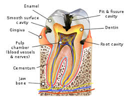 tooth decay wikipedia