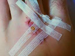 How many strips you need will depend on the size of the wound. Wound Closure Strip Wikipedia