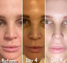 Embarrassing bodies star dr jessen was last week ordered by a judge at the high court in belfast to pay damages for posting the outrageous. Danielle Lloyd Unveils The Results Of Her Nose Job Just 16 Days After Surgery In Turkey Aktuelle Boulevard Nachrichten Und Fotogalerien Zu Stars Sternchen