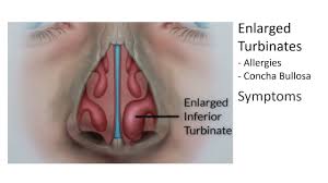 The goal of the surgery is to remove the whole tumor and a small amount of normal. Nasal Turbinates California Sinus Centers Sinus Surgeons Ent Doctors Bay Area
