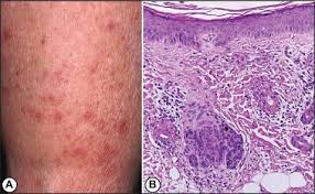 Image result for Microscopic Polyangiitis