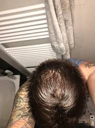 This means that dutasteride is more effective at stopping the conversion of testosterone into dht. Topical Dutasteride Saved My Hair T Replacement Forums T Nation