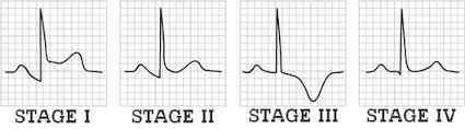 Entzündungen am herzenin diesem podcast werden systematisch myokarditis, endokarditis und perikarditis erläutert. Ecg Changes In Pericarditis Epomedicine