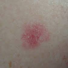 Skin cancer is by far the most common type of cancer. Iec Or Bowens Disease Brisbane Moles My Skin Cancer Centre