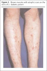 Image result for Pigment stains on the shin