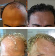 L'alopecia androgenetica femminile e maschile non solo comportano un . Trapianto Capelli Milano 2390 39 90 Al Mese Trapianto Capelli Tecnica Microfue