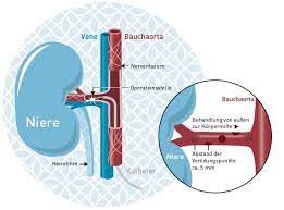 Renale Denervation Definition Ablauf Und Mogliche Komplikationen