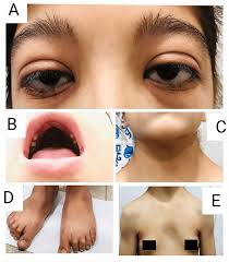 Image result for Webbed Neck