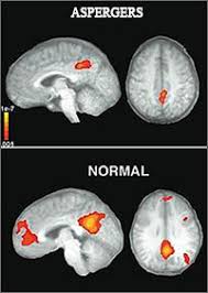 Though the diagnosis of asperger syndrome is no longer used, many previously diagnosed people still identify strongly and positively with being an aspie. Neuroscience Sheds Light On Why People With Asperger S Syndrome Lack Empathy