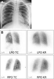 Image result for Ventilation Perfusion Scan