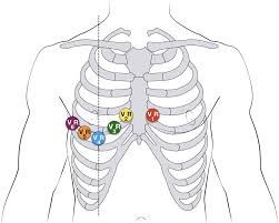 Maybe you would like to learn more about one of these? Ecg Lead Positioning Litfl Ecg Library Basics
