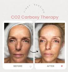CO2 Carboxy Therapy