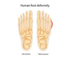 In most cases, treatment can. Small Bump On The Side Of The Foot What Is A Bunionette Dallas Podiatry Works