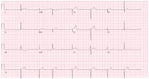 The most common cause is idiopathic fibrosis and sclerosis of the conduction system. Full Text Recurrent Myocardial Infarctions In A Young Football Player Secondary Imcrj