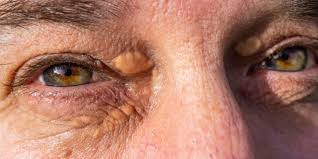 Image result for xantelasma