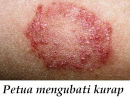 Ubat ni pulak hanya boleh didapati dikedai jamu dan ubat tradisional. Nama Ubat Kurap Kosong Kerje