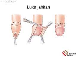 Seorang individu dakwa kaki jadi bengkak dan menggelembung selepas mendapat rawatan di sebuah hospital. Penjagaan Luka Selepas Bersunat Menggunakan Laser
