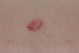 The scf also state that this type of cancer is most common in males. Psoriasis Or Skin Cancer How To Tell The Difference