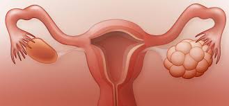 That's why it's called polycystic. an ultrasound can check your ovaries for cysts, look for tumors, and measure the lining of your uterus. Pcos And Tcm How We Can Help Acunatural Health