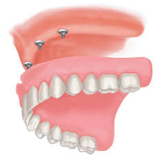 For example, mini dental implants. Implant Overdenture Low Cost Dental Implants In Delhi India Shanti Dentals