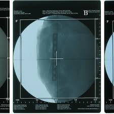 Of the 43 people whose implants did set off the airport security alarms, additional security checking. X Ray Radiographs Of A Stainless Steel Implant A A Titanium Implant Download Scientific Diagram