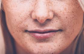 Skin Cancer and Melanoma: New Screening Guidelines