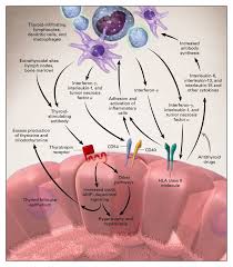 Graves Disease Nejm