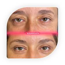 Image result for xantelasma