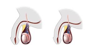 It is more common in boys who are going through puberty. Torsion Of The Appendix Testis And Appendix Epididymis Children S Hospital Of Philadelphia