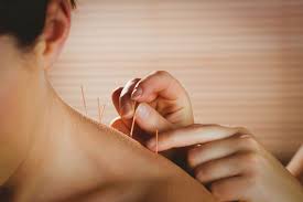 Image result for Acupuncture