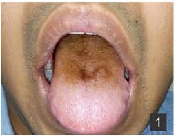 Image result for black hairy tongue symptoms