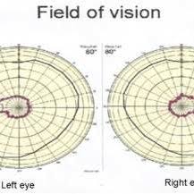 Perimetry Chart Field Of Vision Normal Vision Marked By