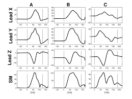 Orientation of particle motion relative to the direction of energy propagation is one way waves are characterized. Different Types Of P Wave Morphology Typical Examples Of Type 1 P Download Scientific Diagram
