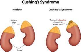 Diagnostico Da Sindrome De Cushing