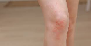 Image result for Atopic eczema atopic dermatitis