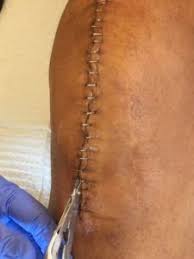 Pin On Knee Replacement Surgery