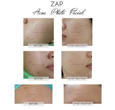 Mungkin supaya customer tidak kaget ya dengan harganya. Review Treatment Photo Facial Acne Di Zap Clinic Sprinkle Of Rain