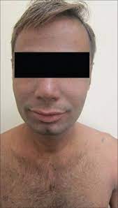 Dry skin can be moisturized. Naegeli Franceschetti Jadassohn Syndrome A Rare Case Abstract Europe Pmc