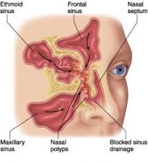 Medication or surgery can help. ØµÙˆØ±Ø© Ø°Ø§Øª ØµÙ„Ø© Polyp Sinus Polyps How To Stay Healthy