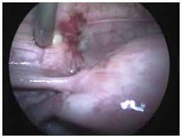 Fontos tudni, hogy az endometriózis következtében meddőségi problémák is felléphetnek. Endometriozis Infravizsgalat Hu Emberi Test Infra Vizsgalata