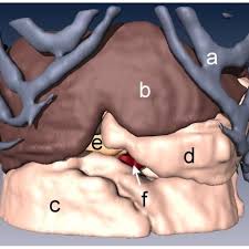 Organs of the left side deflected to the right. Organs Displayed In This Rendering Include A Rib Cage B Liver C Download Scientific Diagram