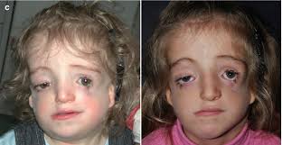 Treacher collins syndrome (tcs) is characterized by bilateral and symmetric downslanting palpebral fissures, malar hypoplasia, micrognathia, and external ear abnormalities. Treacher Collins Franceschetti Syndrome Springerlink
