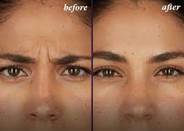 We would like to show you a description here but the site won’t allow us. Botox Treatment Before And After La Fontaine Aesthetics