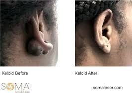 Image result for Keloid